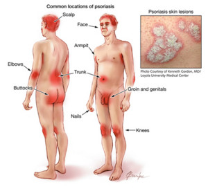 Изменения псориаза чаще всего появляются   они там, где кожа самая слабая (питаемая)